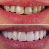 لمینت متحرک دندان|آرایشی، بهداشتی، درمانی|زابل, |دیوار