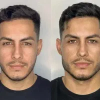 تزریق ژل و .. با تخفیف