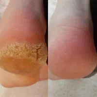 با یه جلسه پاهاتو مثل پای نوزاد کن