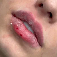 تخفیف بوتاکس،ژل لب،پی ار پی فقط تا فردا(۱ آبان)|خدمات آرایشگری و زیبایی|یاسوج, |دیوار