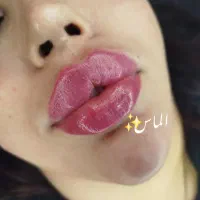 تزریق ژل و بوتاکس