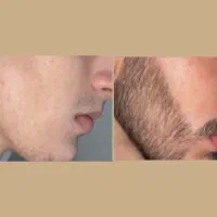 حجم آوری، پر پشتی ،رشد ،سبیل ، مو