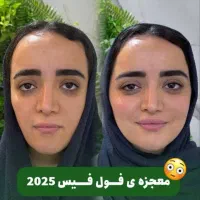 جشنواره تزریق ژل و لیفت صورت