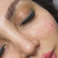 فیلر بوتاکس مزوتراپی جوانساز