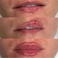 ژل،بوتاکس،مزوتراپی، فیشیال در سالن زیبایی