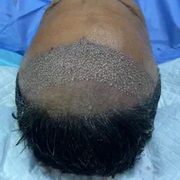 کاشت مو|خدمات آرایشگری و زیبایی|آبادان, |دیوار