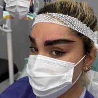 کاشت ابرو - با متد لیفت تخفیف ویژه 14/800