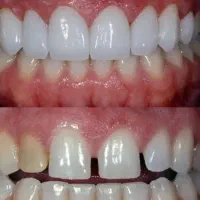 جشنواره کامپوزیت،لمینیت وبلیچینگ وخدمات دندانپزشکی|خدمات آرایشگری و زیبایی|شاهین‌شهر, مخابرات (شهید بهشتی)|دیوار