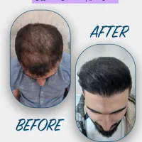 کاشت تخصصی مو و ابرو در درمانگاه مجاز