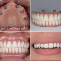 دندانپزشکی اوردنچر دوفک فقط ۱۰۰ تومن در تبریز