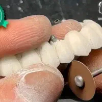 کاشت ایمپلنت دندان دیجیتال یه روزه فقط 10900