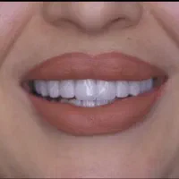 کامپوزیت ونیر کامپوزیت زیبایی لمینیت دندان بلیچینگ