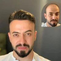 جشنواره کاشت مو دکتر راکعی .اقساط ۱۲ ماهه بدون سود