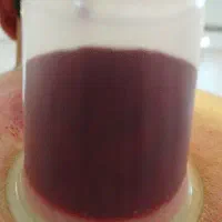 پرستارطب سنتی حجامت بادکش تزریقات درمنزل|خدمات آرایشگری و زیبایی|مشهد, گلبرگ شمالی|دیوار