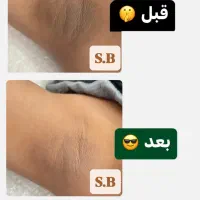 پکیج طلایی پلاژن + لیزر رفع تیرگی و‌سفید کننده