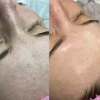فیشیال،پلاژن تراپی برای بانوان و آقایان درمطب پزشک|خدمات آرایشگری و زیبایی|شیراز, قدوسی غربی|دیوار