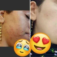 کرم ضدلک و‌جوش و سفید کننده|آرایشی، بهداشتی، درمانی|دهدشت, |دیوار