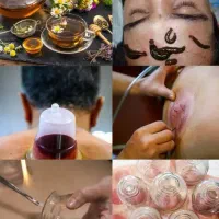 حجامت. بادکش درمانی. زالو درمانی|خدمات آرایشگری و زیبایی|یاسوج, |دیوار