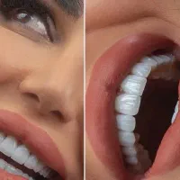 عصب کشی ۱۴۰۰/کامپوزیت ۵/لمینت۷/روکش۴/ایمپلنت