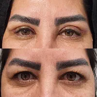 عمل(افتادگی پلک بالا و پایین )عمل زیبایی( گوش)|خدمات آرایشگری و زیبایی|فسا, |دیوار