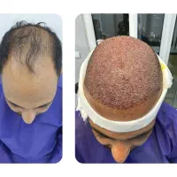 کاشت ابرو. میکرو گرافت.  بدون جراحی|خدمات آرایشگری و زیبایی|تهران, ازگل|دیوار