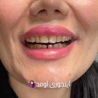 کامپوزیت دندان|خدمات آرایشگری و زیبایی|اهواز, نادری|دیوار