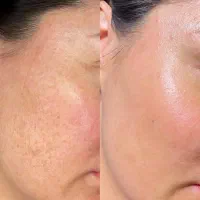 کرم ضد لک بیوممتیک