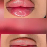 انواع ژل بوتاکس وزیبایی صورت