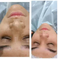 پاکسازی و فشیال پوست