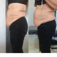 دستگاه لاغری وجوانسازی لیپوزیرو