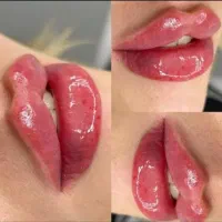 تزریق ژل لب و گونه و چانه.. (جشنواره)درمطب فقط500ت