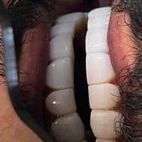 مدل کامپوزیت زیر نظر پزشک در کلینک دنداپزشکی|خدمات آرایشگری و زیبایی|اهواز, کیانپارس |دیوار