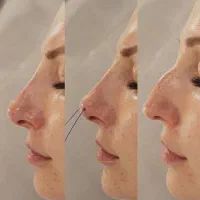 پزشک متخصص ژل و بوتاکس لیفت بانخ افزایش سایزآلت|خدمات آرایشگری و زیبایی|قم, صفائیه|دیوار