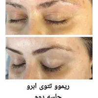 هایفو جوانساز، کیوسوئیچ، ریموو تتو،لیزر موهای زائد|خدمات آرایشگری و زیبایی|آبادان, |دیوار