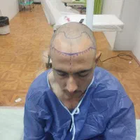 کشت مو ب روش fit|خدمات آرایشگری و زیبایی|کرمان, |دیوار