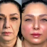 ساکشن شکم و پهلو در مرکز زیبایی روجا