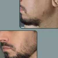 معجزه ریش و سیبیل وپرپشتی مو
