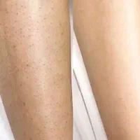 لیزر لک کک و مک و رفع تتو ولیزرموهای زاید|خدمات آرایشگری و زیبایی|نسیمشهر, |دیوار