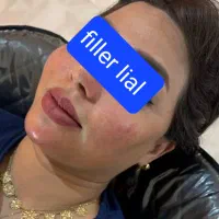 آف خدمات تخصصی ژل بوتاکس