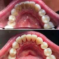 انجام خدمات جرمگیری دندان و ترمیم دندان های پوسیده|خدمات آرایشگری و زیبایی|آبادان, |دیوار