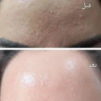 حلزون وخاویار