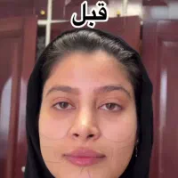 تزریق چربی ، تزریق ژل ، بوتاکس ، جراحی در مطب|خدمات آرایشگری و زیبایی|نورآباد, |دیوار