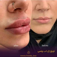 تزریق فیلر بوتاکس390 لیزر زاویه متدmd codeمزوپزشک|خدمات آرایشگری و زیبایی|تهران, طرشت|دیوار