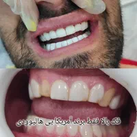 مدت محدود آموزش کامپوزیت لیرینگ دندان،روش frc|خدمات آرایشگری و زیبایی|کرج, چهارصد دستگاه|دیوار
