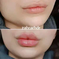 خدمات ژل فیلربوتاکس مزوژل درکلینیک با اف ویژه