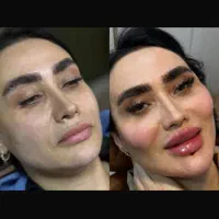 ژل وبوتاکس نورامیس فقط وفقط ۹۹۹|خدمات زیبایی و سلامت|تهران, سجاد|دیوار