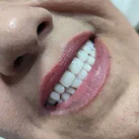 دندان مصنوعی وارداتی هر فک ۵ تومان|خدمات آرایشگری و زیبایی|کرج, کمالشهر|دیوار