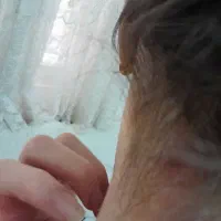 راهنمایی برای درمان پسوریازیس