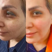 اموزش و خدمات بوتاکس و فیلروفیشیال و فیلر بادی|خدمات آرایشگری و زیبایی|شیراز, کوشک میدان|دیوار
