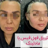 تخفیف فیلر صورت|خدمات آرایشگری و زیبایی|اهواز, زیتون کارمندی|دیوار